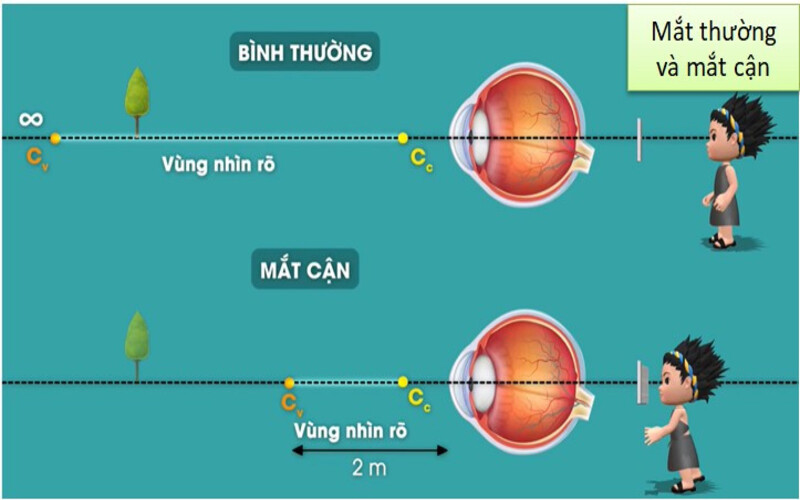 Cận thị là một tật khúc xạ phổ biến khiến tầm nhìn xa bị mờ. Nhiều người thắc mắc cận thị bao nhiêu độ thì nên đeo kính để bảo vệ mắt và duy trì thị lực tốt nhất. Việc đeo kính đúng thời điểm sẽ giúp hạn chế tình trạng tăng độ cận nhanh chóng và cải thiện chất lượng cuộc sống. Hãy cùng tìm hiểu chi tiết qua bài viết dưới đây!