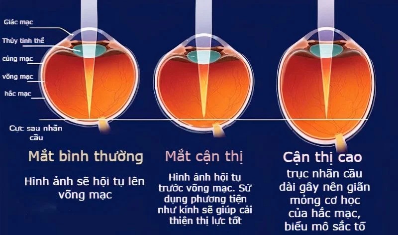 Cận thị là một tật khúc xạ phổ biến khiến tầm nhìn xa bị mờ. Nhiều người thắc mắc cận thị bao nhiêu độ thì nên đeo kính để bảo vệ mắt và duy trì thị lực tốt nhất. Việc đeo kính đúng thời điểm sẽ giúp hạn chế tình trạng tăng độ cận nhanh chóng và cải thiện chất lượng cuộc sống. Hãy cùng tìm hiểu chi tiết qua bài viết dưới đây!